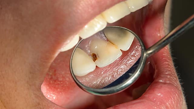 爛牙的成因, 症狀, 有效的治療及預防方法 - 高露潔香港